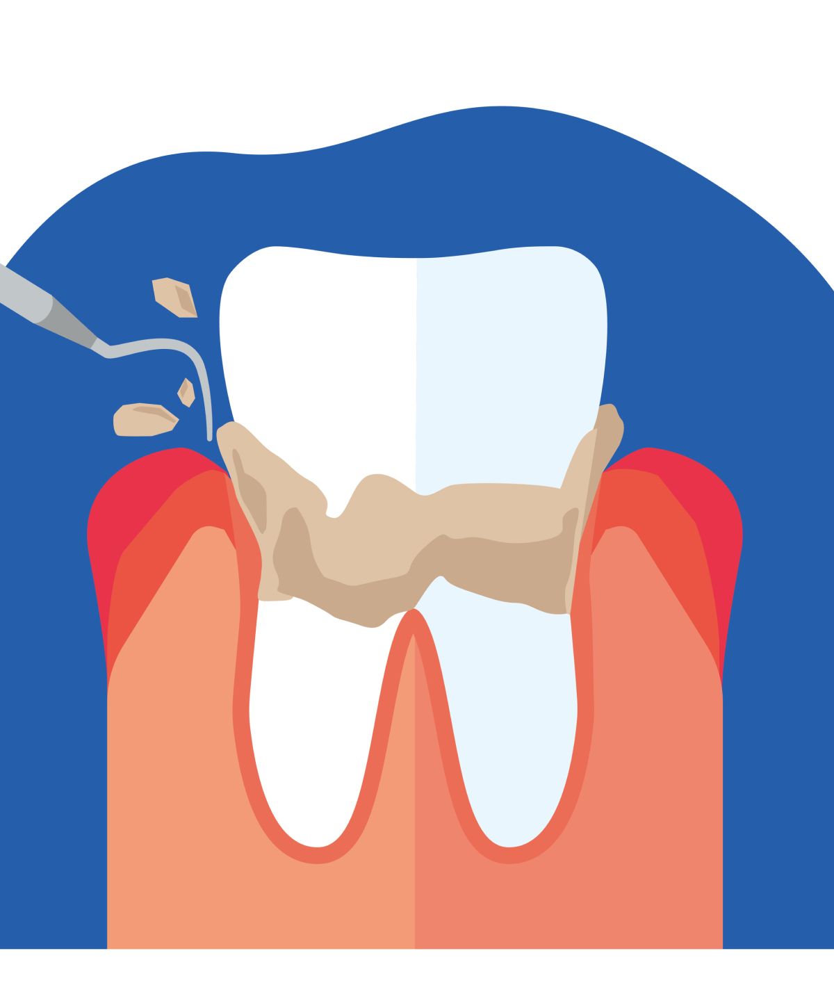 Dental illustration of tooth decay treatment process.
