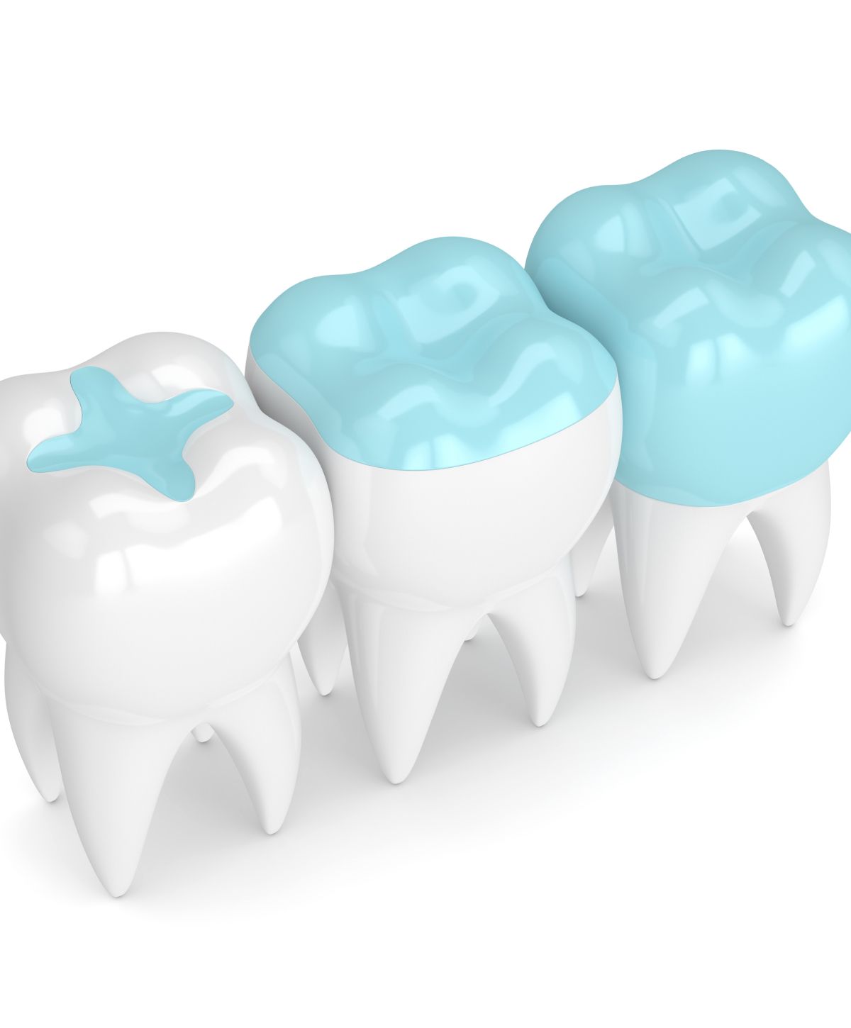 Dental sealants on white teeth model.