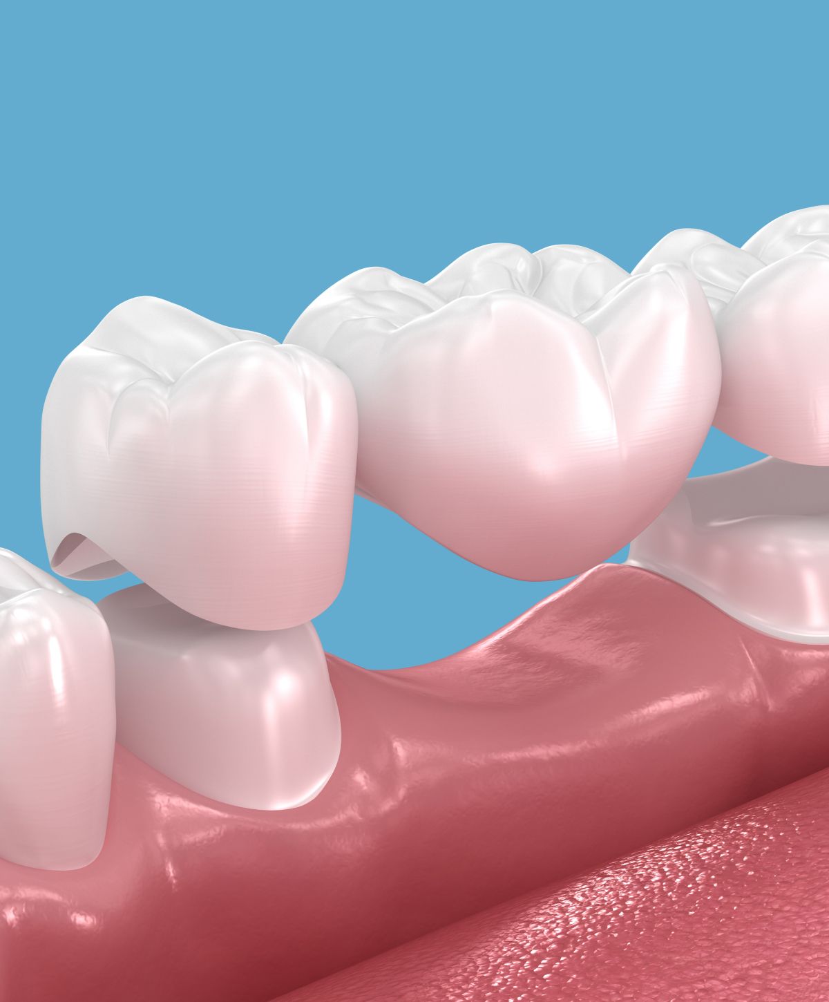 Close-up of dental crowns on gums.