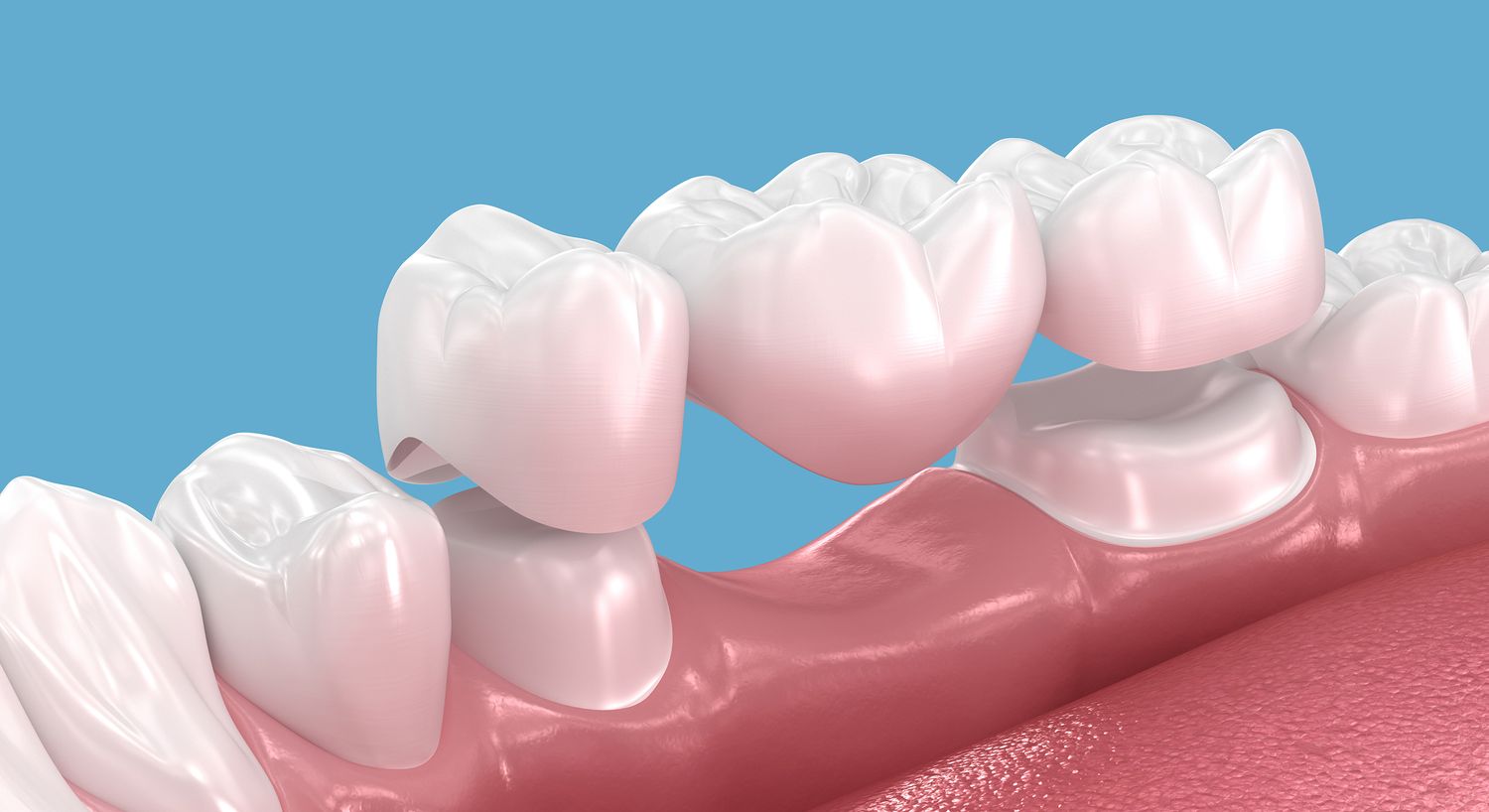 Dental illustration of teeth and gums.