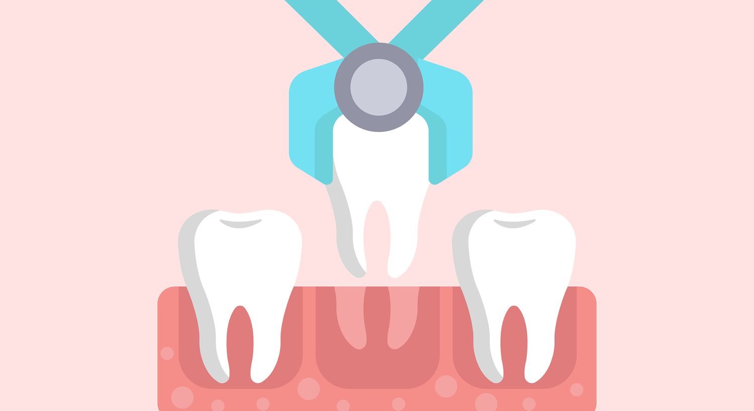 Dental extraction procedure illustration with teeth.